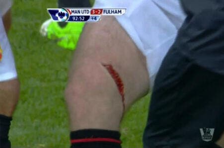 Photo : L'incroyable blessure de Rooney contre Fulham