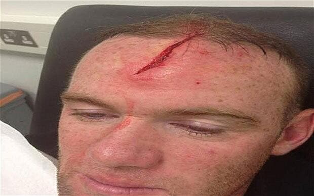 Photo : Rooney montre sa tête pour justifier son forfait